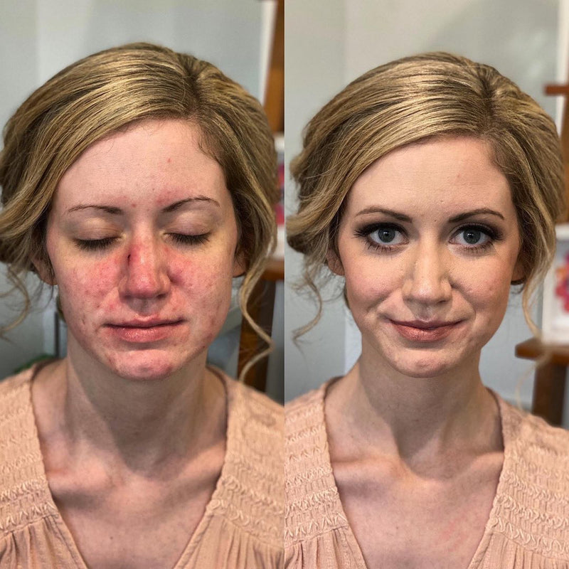 Before and After Loose Mineral Foundation on acne prone skin